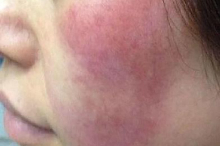 面部皮肤动脉性充血图