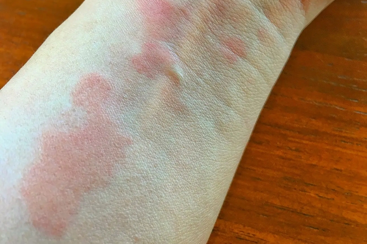 对木屑过敏后,常会自觉皮肤瘙痒,出现大小不等的红色风团样荨麻疹,呈