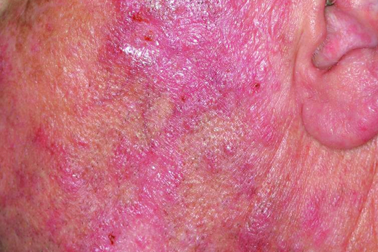 盘状红斑狼疮图 盘状红斑狼疮图