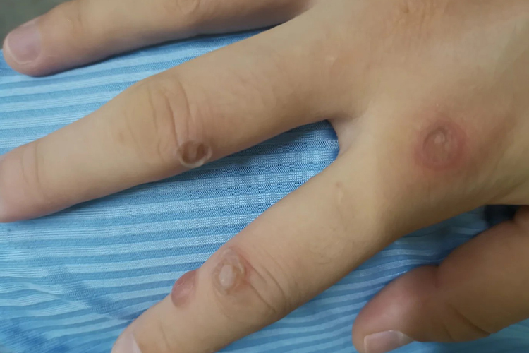 冷冻扁平疣结痂图