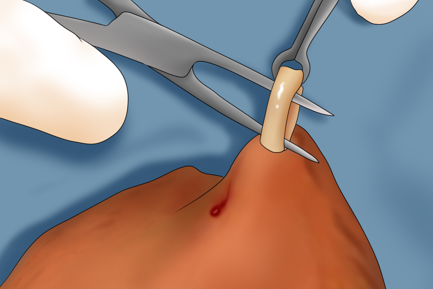 结扎切断鞘状突图