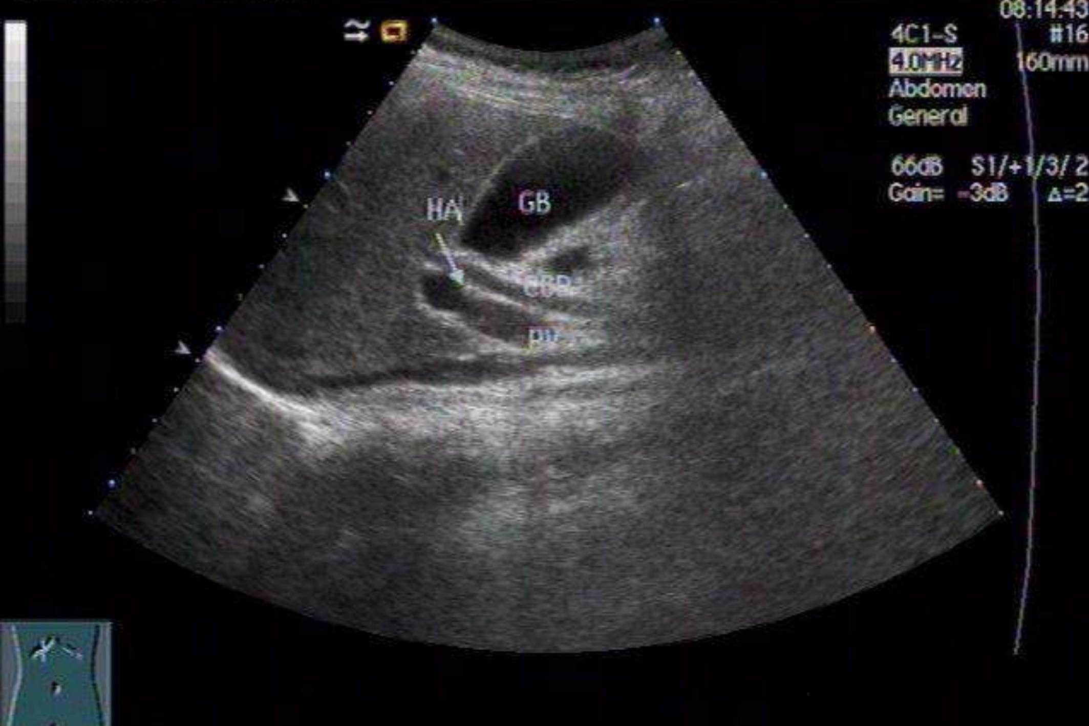 正常胆囊声像图 正常胆囊声像图