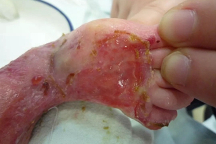 疱疹样天疱疮脚背症状图