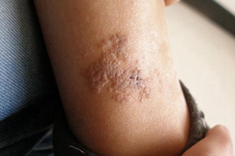 表皮痣胳膊症状图 表皮痣胳膊症状图