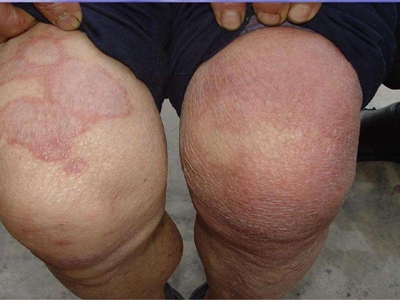 结核样型麻风膝盖上有大片红斑图