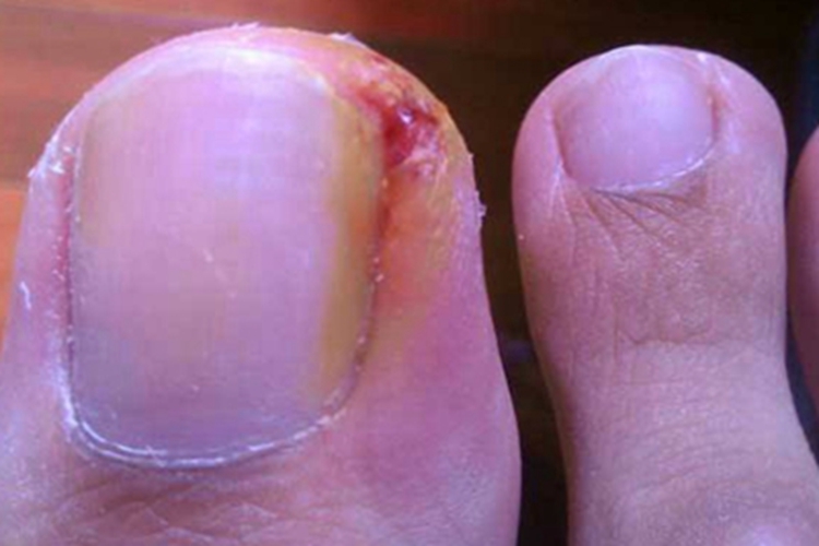 慢性甲沟炎脚趾甲红肿图