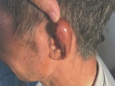 耳廓化脓性软骨膜炎鼓个大包图.jpg