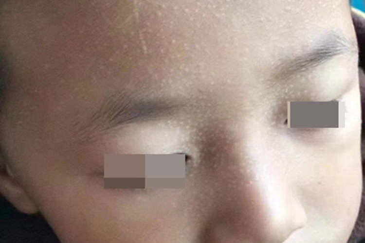 光泽苔藓面部小疙瘩图