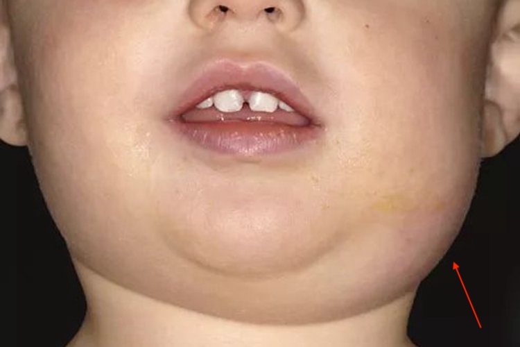 流行性腮腺炎腮腺肿大图 流行性腮腺炎腮腺肿大图