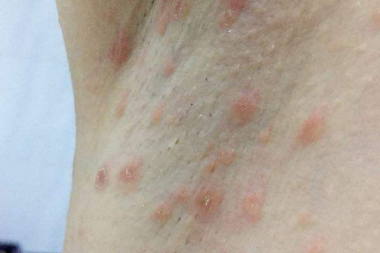 腋下发红疼痛图片