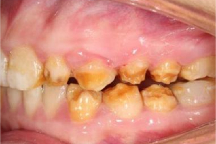 牙釉质发育不全症状图 牙釉质发育不全症状图