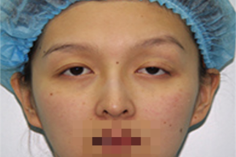 鼻咽癌左上眼皮耷拉图 鼻咽癌左上眼皮耷拉图