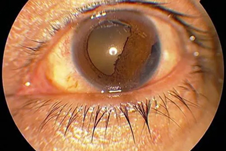 典型性虹膜缺损黑眼球边缘缺损图