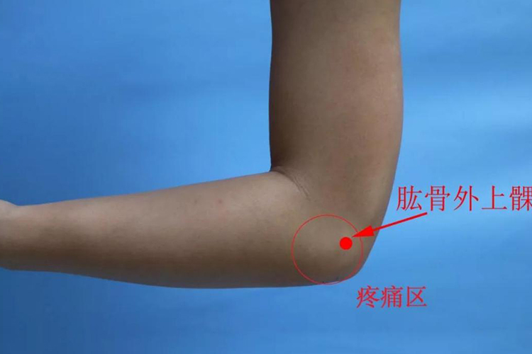 肱骨外上髁炎位置图