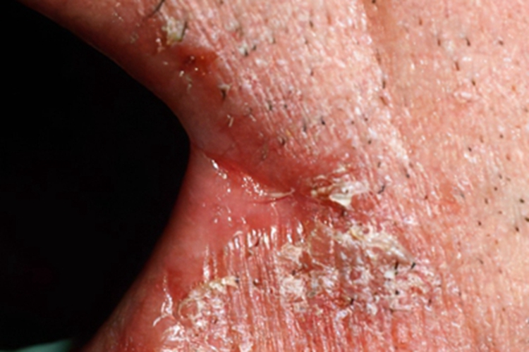 口角炎口周症状图