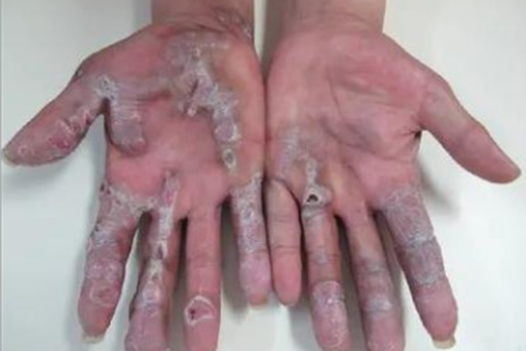 持久性隆起性红斑手部长斑图