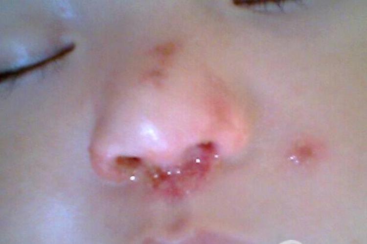 小孩鼻单纯疱疹图