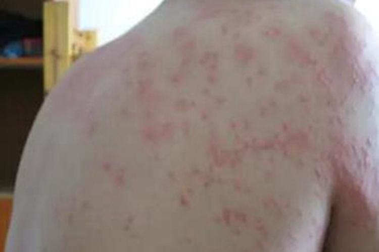 荨麻疹背部丘疹图