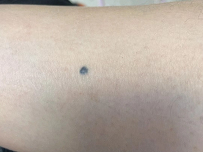 普通蓝痣胳膊上长了个蓝色的痣图.jpg