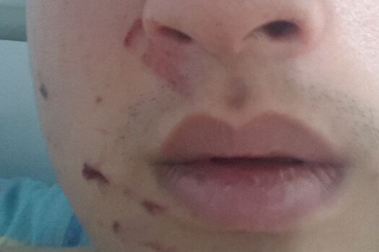 鼻外伤鼻梁两侧肉鼓起图 鼻外伤鼻梁两侧肉鼓起图