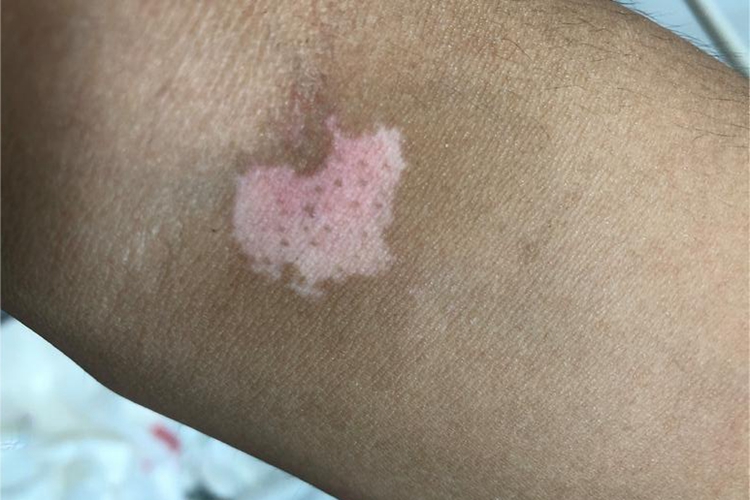 稳定期节段型白癜风肘部症状图