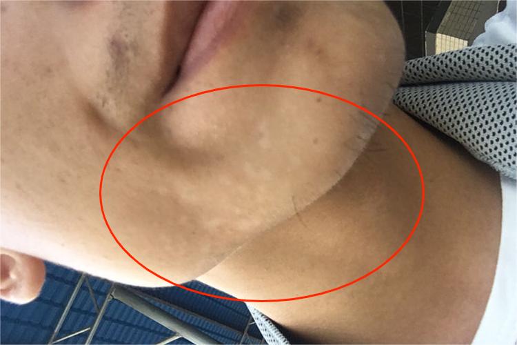 花斑糠疹下巴症状图