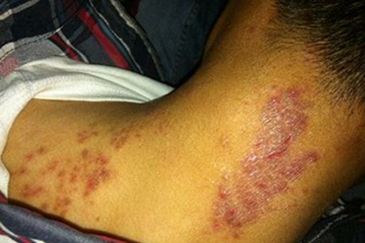 放射性皮炎红斑图