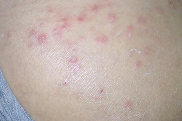 儿童丘疹性肢端皮炎臀部症状图