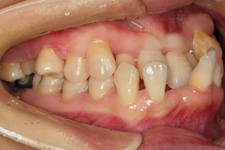 慢性牙周炎牙齿缺失图