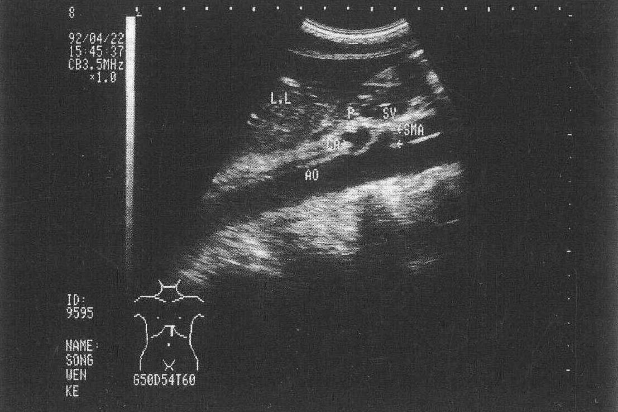 正常肝脏声像图 正常肝脏声像图