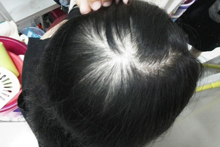 女性脂溢性脱发Ⅲ级图 女性脂溢性脱发Ⅲ级图