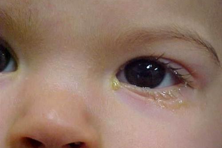 泪阜长白色颗粒图