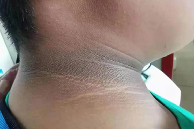 假性黑棘皮病皮肤发黑图