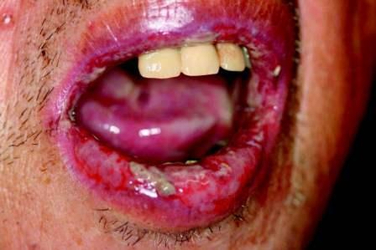 口蹄疫口唇糜烂性水疱图