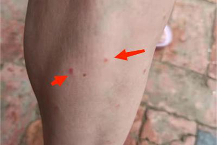 过敏性皮炎小腿上小红点图 过敏性皮炎小腿上小红点图