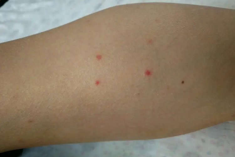 胳膊蚊虫叮咬图