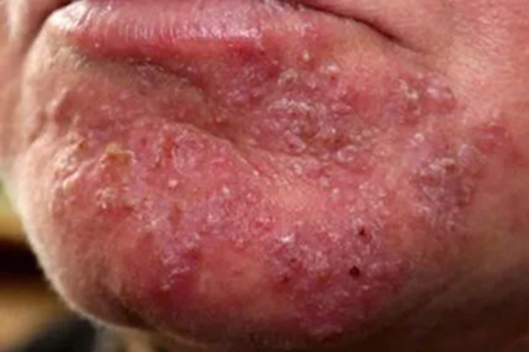 虫咬皮炎黄痂图 虫咬皮炎黄痂图