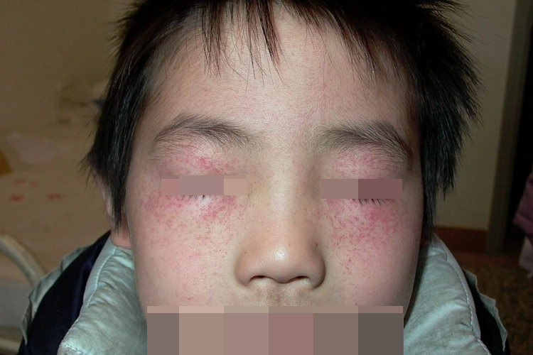 机械性紫癜图 机械性紫癜图