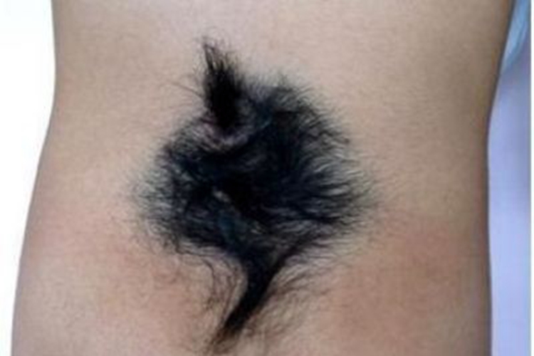 多毛症后腰一大片黑毛图 多毛症后腰一大片黑毛图