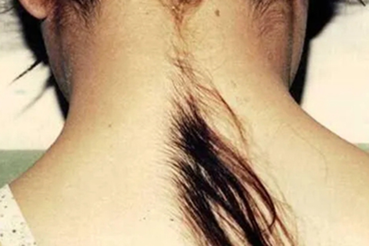 多毛症后颈毛发过长图 多毛症后颈毛发过长图