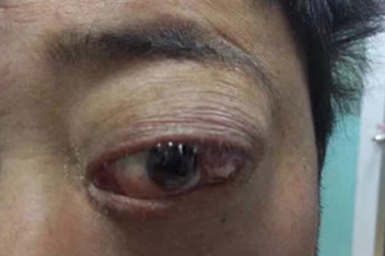 眼眶横纹肌肉瘤眼部凸出图