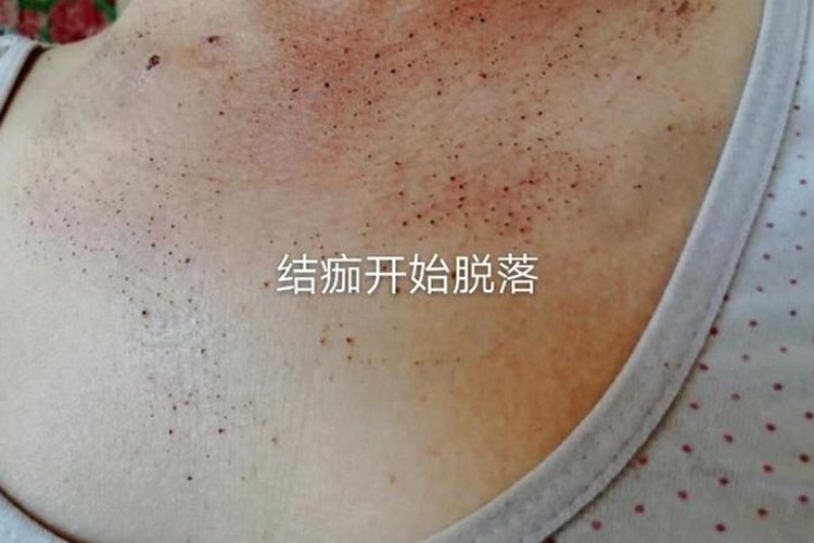 丝状疣激光后掉痂图