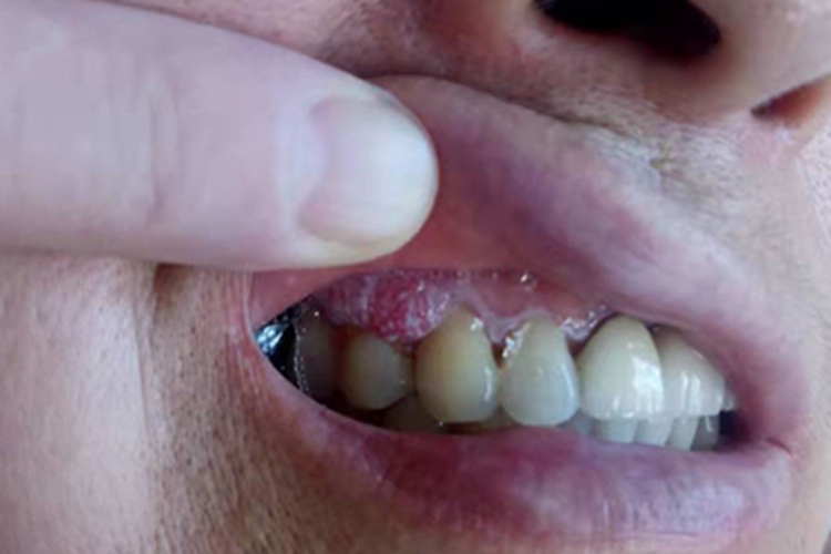 口腔癌牙龈白点图