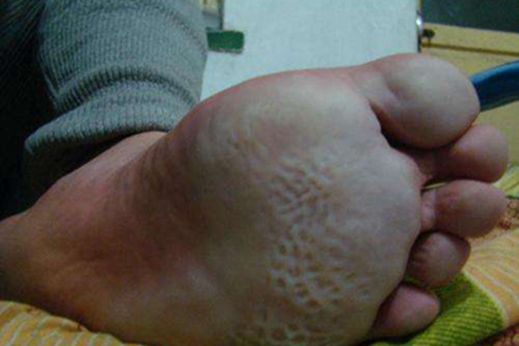 局限型多汗症脚底发白图 局限型多汗症脚底发白图