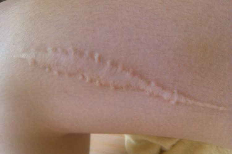 纤维瘤切除后一般疤痕图