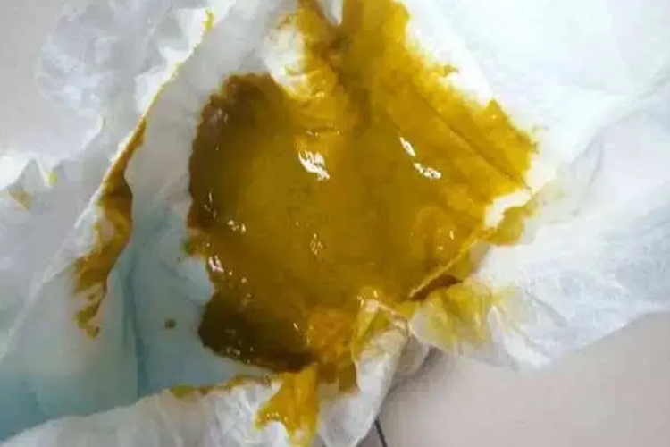 肠易激综合征大便图 肠易激综合征大便图