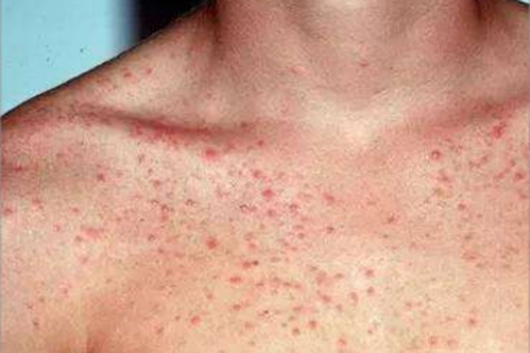 毛囊炎胸部小红疙瘩图 毛囊炎胸部小红疙瘩图