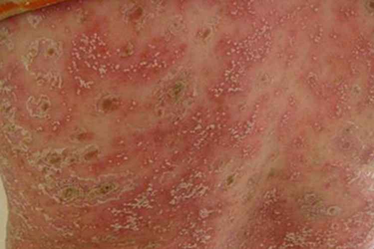 泛发性脓疱型银屑病背部红斑图