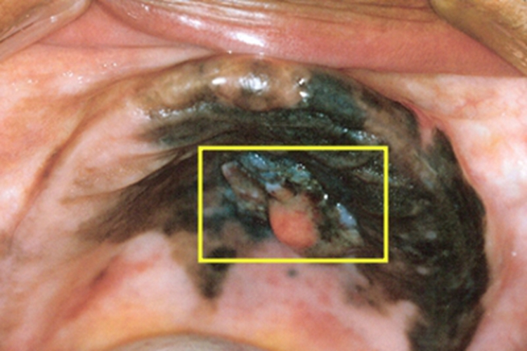 口腔颌面部恶性黑色素瘤糜烂图