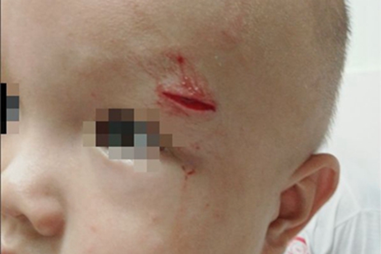 裂伤前额症状图 裂伤前额症状图